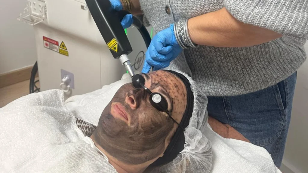 Hollywood Peel